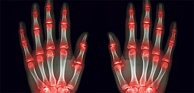 Multiple Arthritis in Fingergelenken: Wichtiges Behandlungsziel ist die Verhinderung struktureller Schäden.
