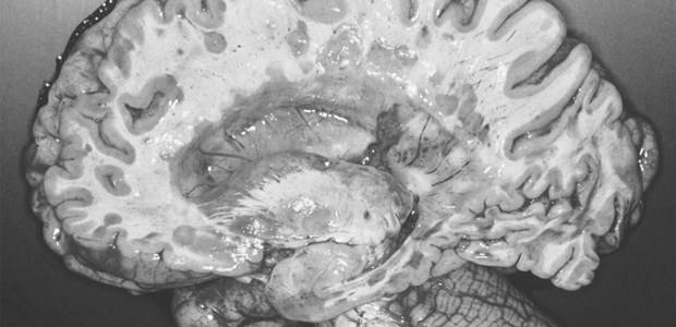 Multiple Sklerose: zahlreiche graue Plaques von demyelinisierten Bezirken in der weißen Substanz.