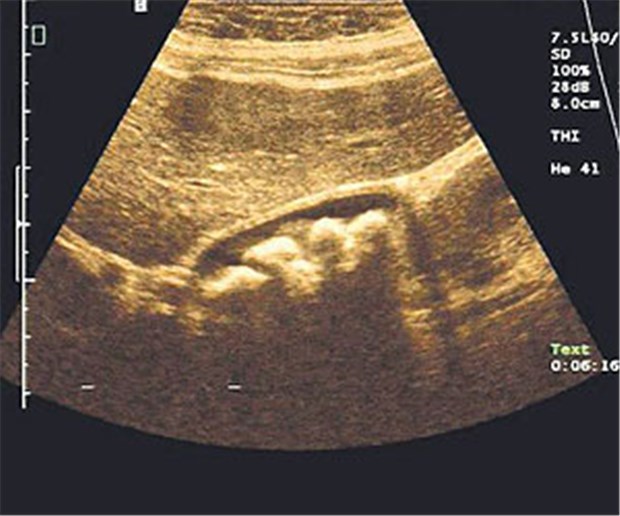 Gallensteine können Dünndarmkrebs auslösen Multiple kleinere Gallensteine, echoreiche, grenzwertig dicke Gallenblasenwand, schmales Lumen bei chronischer Cholecystitis.