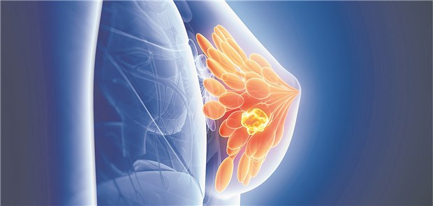 Muskelabbau und Adipositas verschlechtern die Prognose von Brustkrebspatientinnen.