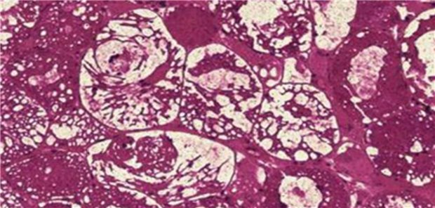 Muskelbiopsie (PAS-Färbung) mit Nachweis der Glykogenspeicherug (Glykogenspeichererkrankung Typ II, Morbus Pompe).
