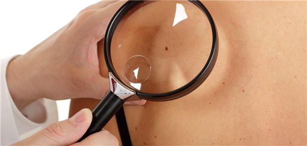 Muss bei Patientinnen und Patienten, die Antihypertensiva einnehmen, genauer auf potentielle Melanome geachtet werden? Eher nicht, ist das Ergebnis einer Fall-Kontroll-Studie.
