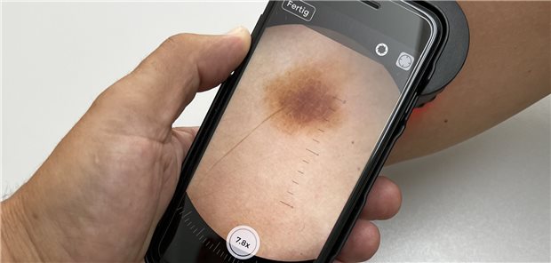 Muss ein Patient für die Diagnostik in die Praxis kommen, oder reicht die Ferndiagnostik? Abbildung einer digitalen Auflicht-Mikroskopie. Telemedizin macht besonders bei den Dermatologen vieles möglich.
