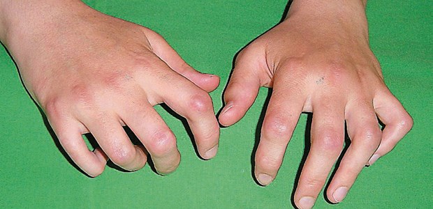 Eine Krankheit, die oft nach der Kindheit bleibt Mutilierende Fehlstellung an den Händen durch eine langjährige juvenile idiopathische Arthritis.