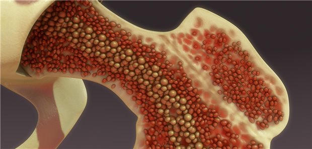 Myeloproliferative Neoplasien und andere hämatologische Erkrankungen haben oft im Knochenmark ihren Ursprung. Eine Therapie mit Metformin kann vielleicht das Risiko der Entstehung senken.