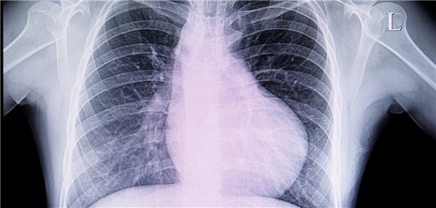 Myokardiale Hypertrophie: Hannoveraner Forscher arbeiten an einem neuen, RNA-basierten Therapiekonzept.