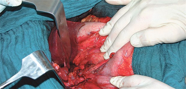 Lang leben nach Lebend-Leberspende Nach Angaben der Deutschen Stiftung Organtransplantation lag 2013 der Anteil an Lebend-Leberspenden in Deutschland bei 8,3 Prozent.