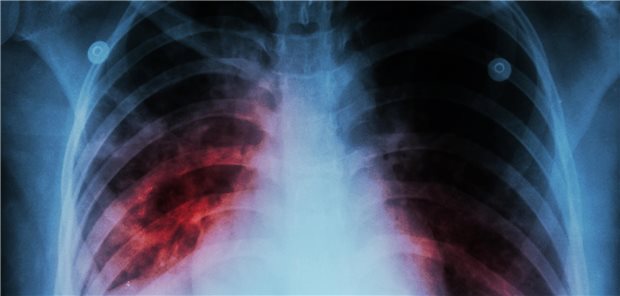 X-ray eines Torsos um in die Lunge zu schauen.