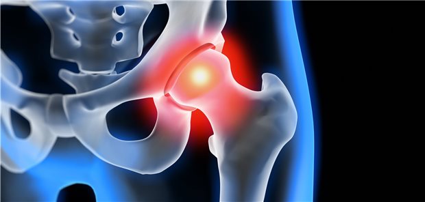 Nach Hüftfraktur ist das Insultrisiko im ersten Monat zehnmal und im ersten Jahr doppelt so hoch wie im Bevölkerungsdurchschnitt.