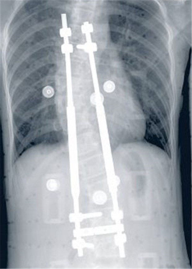 Mitwachsende Stäbe bringen krumme Kinder-Rücken in Form Nach Versorgung mit dem MAGECTM Spinal System.