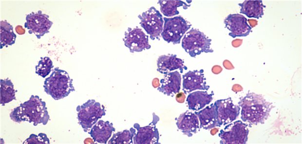 Nach dem längeren Follow-up betrug das mediane Gesamtüberleben in Prüfarm vs. Kontrolle 25,5 Monate vs 12,9 Monate. Das Risiko für Progression oder Tod reduzierte sich unter Glofitamab um 38 Prozent. Auch das mediane progressionsfreie Überleben verlängerte sich auf 13,8 Monate vs. 3,6 Monate.
