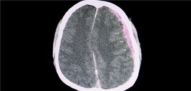 Nach der Diagnose eines intrakraniellen Aneurysmas raten viele Neurologinnen und Neurologen von einem chirurgischen Eingriff ab - sie bergen ein hohes Risiko für bleibende Schäden oder Tod. (Symbolbild)