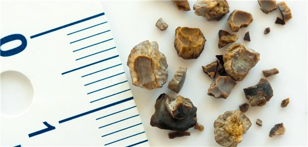 Nach der Entfernung von Harnleitersteinen sollten Ärzte eine bildgebenden Untersuchung durchführen, raten Autoren einer US-Studie.