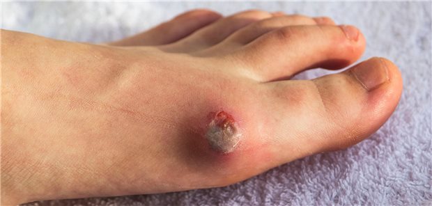 Ein Geschwür am Großzehengelenk