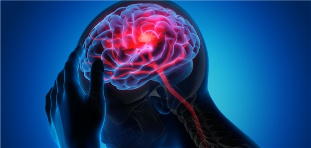 Nach einem Apoplex könnten GLP1-Agonisten möglicherweise nutzen.