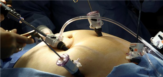 Nach einem laparoskopischen Roux-en-Y-Magenbypass mussten in der Studie insgesamt häufiger erneute Eingriffe vorgenommen werden.