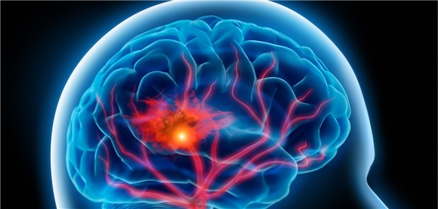 Nach einer Akuttherapie bei Schlaganfall kommt es häufig zu Reperfusionsschäden.