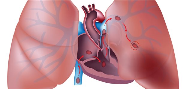 Nach einer Lungenembolie zeigten in einer aktuellen Studie über zwei Jahre 16 Prozent der Patienten sogenannte „Post-LE-Einschränkungen“, z.B. echokardiografische Befunde, die eine pulmonale Hypertonie und/oder eine rechtsventrikuläre Dysfunktion anzeigten.