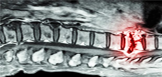 Nach sechs Monaten hatten 69 Prozent mit SBRT sowie 42 Prozent mit EBRT der Patienten mit Wirbelmetastasen eine Schmerzreduktion um mindestens zwei Punkte erzielt – ein signifikanter Unterschied. Relativ betrachtet gelang eine klinisch relevante Schmerzreduktion bei zwei Drittel mehr Personen unter der SBRT als unter EBRT.