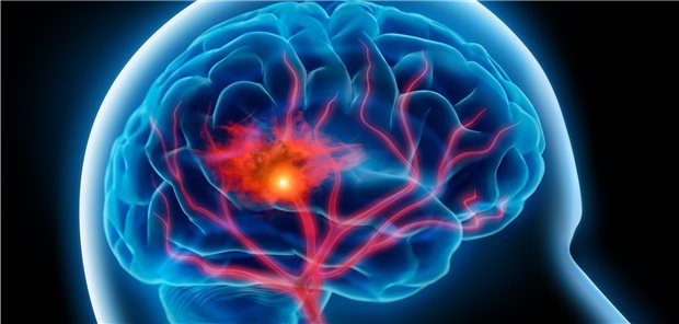 Nach überstandenem Schlaganfall ist die gute Blutdruckkontrolle zur Sekundärprophylaxe essenziell.