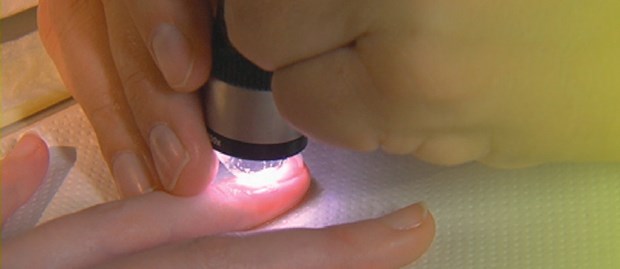 Sklerodermie selten ohne Raynaud Nagelfalzkapillaren untersuchen bei Raynaud.