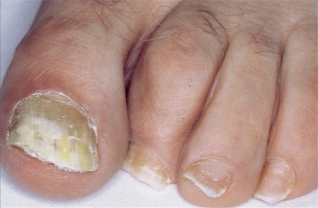 Bei Nagelpilz ist oft Kombitherapie nötig Nagelmykose mit typischen gelblichen, krümeligen Nagelplatten.
