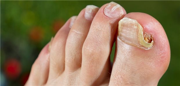 Nagelpilz: Mit einem 3D-Druckverfahren soll eine authentische Nachbildung mit Nagelbett und -platte entwickelt werden.