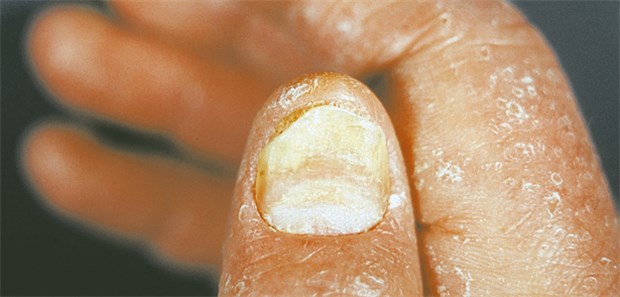 Nagelpsoriasis: Ein Blick auf die Nägel des Patienten hilft, eine PsA frühzeitig zu erkennen.