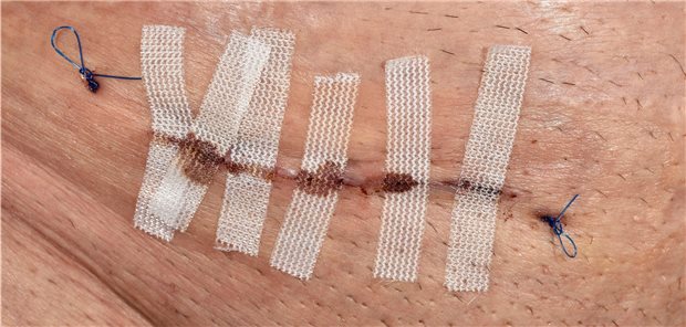 Naht nach einer Hernie-Op