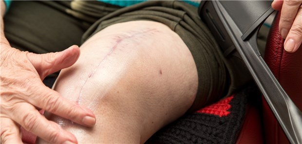 Narbe nach Kniegelenkersatz: Sollte nach dem operativen Eingriff länger antikoaguliert werden? 