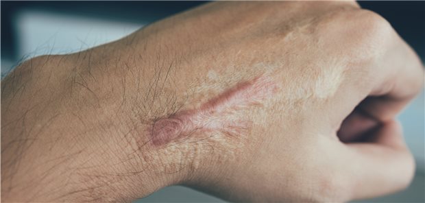 Narbenkeloid an der Hand: Die wichtigsten Behandlungsoptionen bleiben die Injektion von Triamcinolon.