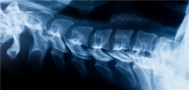 Neben gängigen radiologischen Scoring Systemen, wie dem modified Stoke Ankylosing Spondylitis Spinal Score (mSASSS) und dem Bath Ankylosing Spondylitis Radiology Index (BASRI), die in der Seitaufnahme nur Verknöcherungen an den Wirbelkörpern berücksichtigen, beurteilten die Wissenschaftler die HWS auch mit der Methode nach De Vlam, die ein Scoring jedes Facettengelenk auf Höhe von C2-C7 erlaubt.