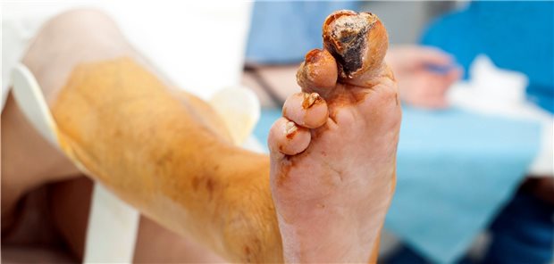 Nekrose am großen Zeh bei diabetischem Fußsyndrom. Ein Zeh wurde bereits amputiert.