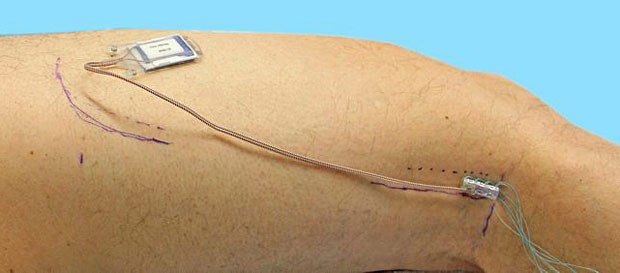 Apoplexie: Implantat im Oberschenkel hilft beim Gehen Nervenprothese im Oberschenke: Der Schrittmacher soll die Fußheberschwäche eines Patienten lindern, der nach Schlaganfall eine Halbseitenlähmung hat.