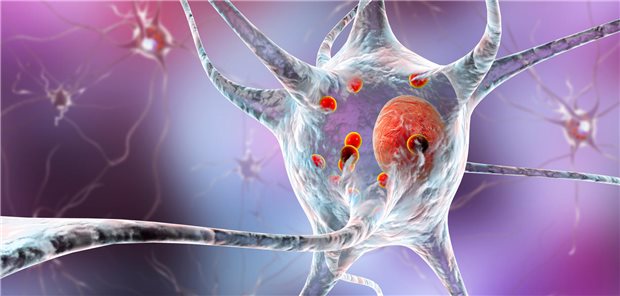 Nervenzelle mit Lewy-Körperchen