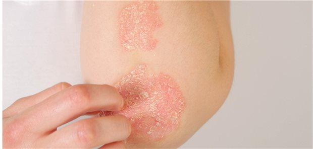 Neu an Psoriasis Erkrankte entwickelten über median 13 Jahre in 2,9 Prozent eine Psoriasis-Arthritis (PsA). Das Risiko dafür war erhöht, wenn sie zur Zeit der Psoriasisdiagnose schon multimorbide waren, und zwar um den Faktor 2,5 (bei MM2) bzw. 3 (bei MM5), sofern Begleiterkrankungen mit potenziellem Bezug zu einer PsA ausgeschlossen wurden.