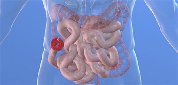 Neue Behandlungswege bei chronisch-entzündlichen Darmerkrankungen (CED): Viele Patienten springen besser auf alternative Methoden an.