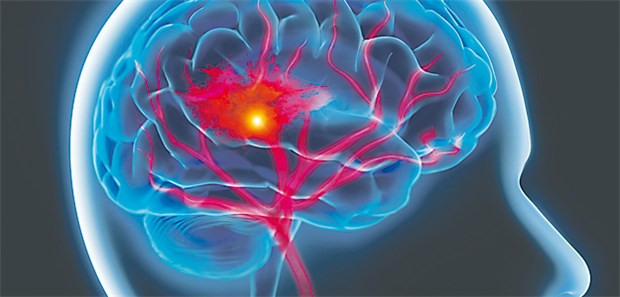 Die Hoffnungsträger bei Hirnblutung Neue Therapiestrategien bei Hirnblutung sind dringend gefragt.