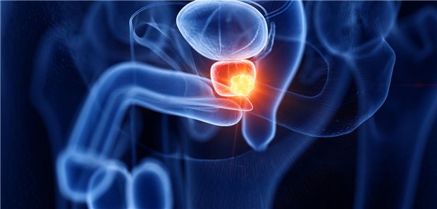 3D-Rendering eines männlichen Genitaltraktes. In der Prostata ist ein Tumor zu erkennen. 