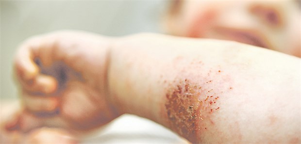Landkinder im Nordosten leiden zunehmend an Allergien Neurodermitis: Laut AOK Nordost die häufigste allergische Erkrankung bei Kindern im Nordosten.