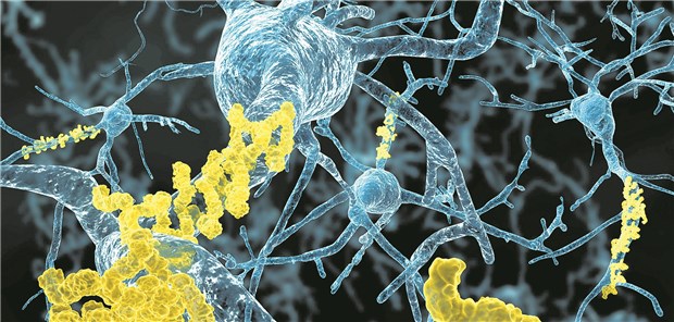 Neuronen mit Amyloid-Plaques (gelb): Neurofilament-Serumwerte korrelieren wohl gut mit Alzheimerbiomarkern wie Beta-Amyloid.