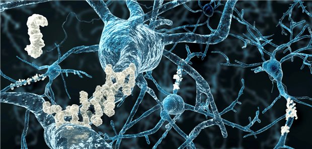 Proteine auf Abwegen – Biochemikerin erhält Alzheimer-Preis Neuronen mit Amyloid-Plaques im Gehirn. Verklumpungen bestimmter Proteine in den Zellen selbst könnten eine weitere Ursache für eine Demenz sein. Daran forscht die Trägerin des Alzheimer-Preises Dorothee Dormann.