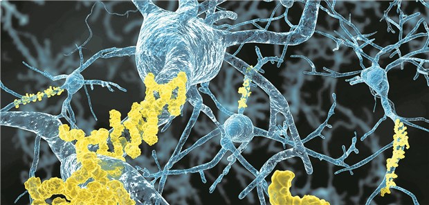Kurskorrektur in der Alzheimerforschung? Neuronen mit Amyloid-Plaques sind ein Merkmal von Morbus Alzheimer – doch längst nicht das einzige.