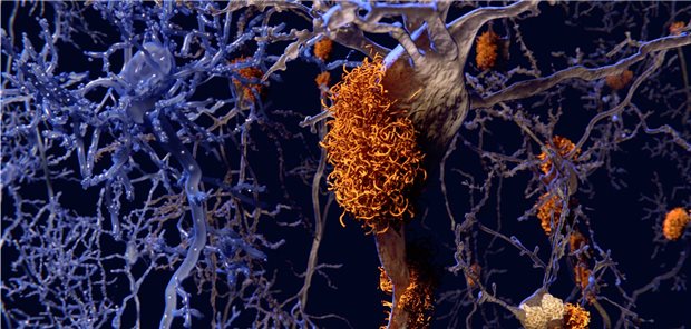 Neuer Bluttest zur Alzheimer-Frühdiagnose Neuronen mit (rechts) und ohne (links) Amyloid-Plaques. Beta-Amyloid ist nach wie vor ein Forschungsschwerpunkt bei Morbus Alzheimer.
