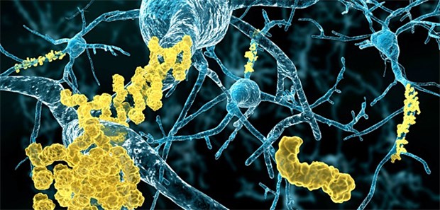 Demenz kündigt sich Jahrzehnte im Voraus an Neuronen und Amyloid Plaques.