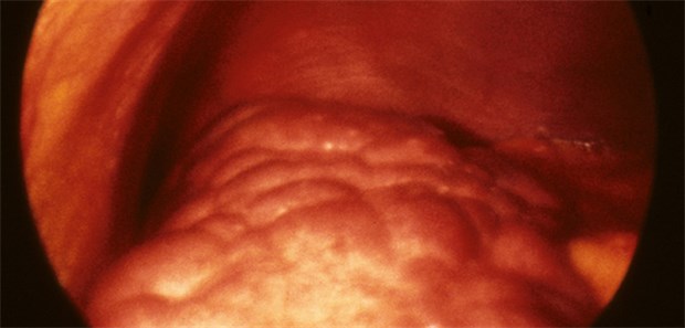 Nicht bei allen Patienten mit Leberfibrose entwickelt sich daraus auch eine Zirrhose (Bild).