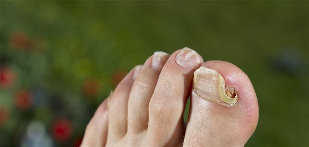 Nahaufnahme eines Fuß mit Nagelpilzschäden