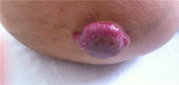 Nicht einmal im Leben, aber eínmal je Erkrankung und Quadratzentimeter sind Farbstofflaser-Behandlungen bei Hämangiomen abrechenbar.