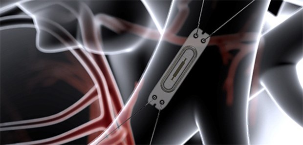 Telemedizin hilft, die Klinik zu vermeiden Nicht größer als eine Büroklammer: Das CardioMEMS-System misst den Blutdruck über einen Drucksensor.