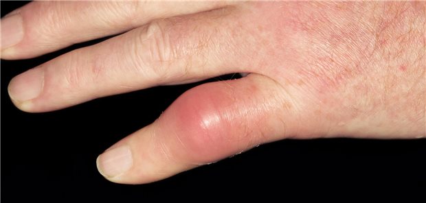 Nicht immer ist es das Großzehengrundgelenk: Hier manifestiert sich der Gichtanfall im PIP des kleinen Fingers.